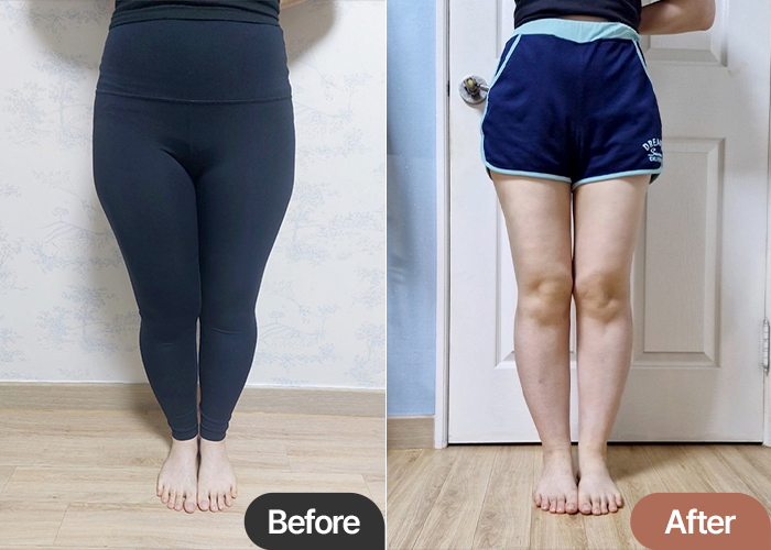 thigh-liposuction-thumbnail-selfie-Heungbune-after