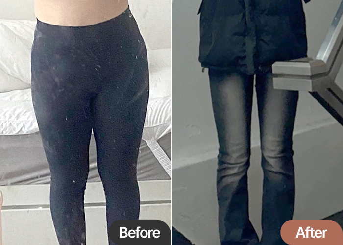 Before and after thigh liposuction of IIxo in Korea—clear difference in upper thigh width and fit of pants.