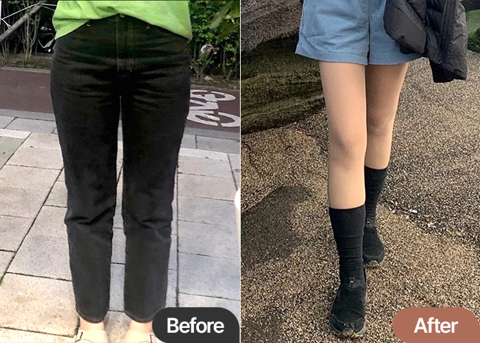Before and after thigh liposuction of Jjondeokhouse in Korea—significant improvement in thigh volume and clothing silhouette.