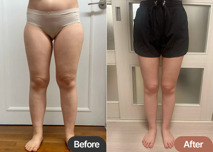 Before and after thigh liposuction of Manimaniyong in Korea—significant thigh gap, straight leg line, and reduced bulk.