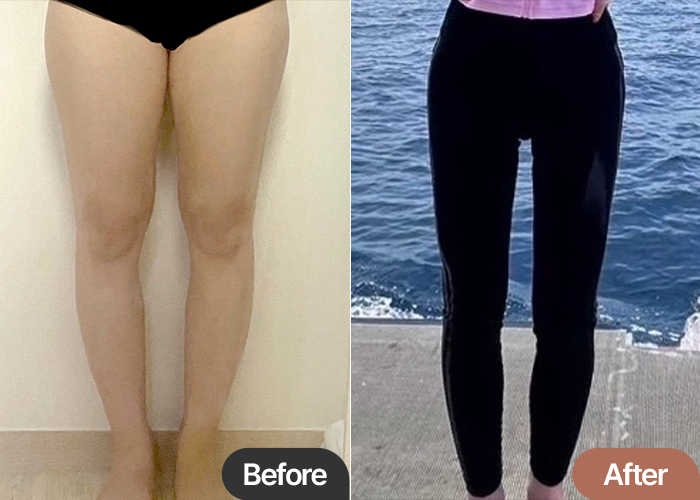 thigh-liposuction-thumbnail-selfie-Namnama