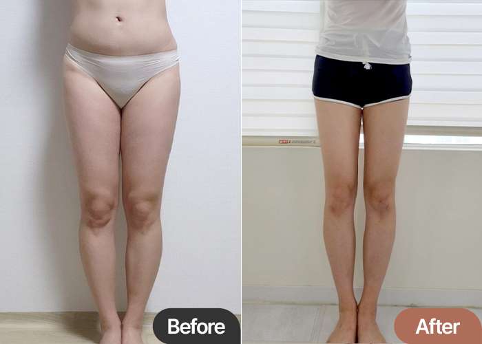 thigh-liposuction-thumbnail-selfie-Niini