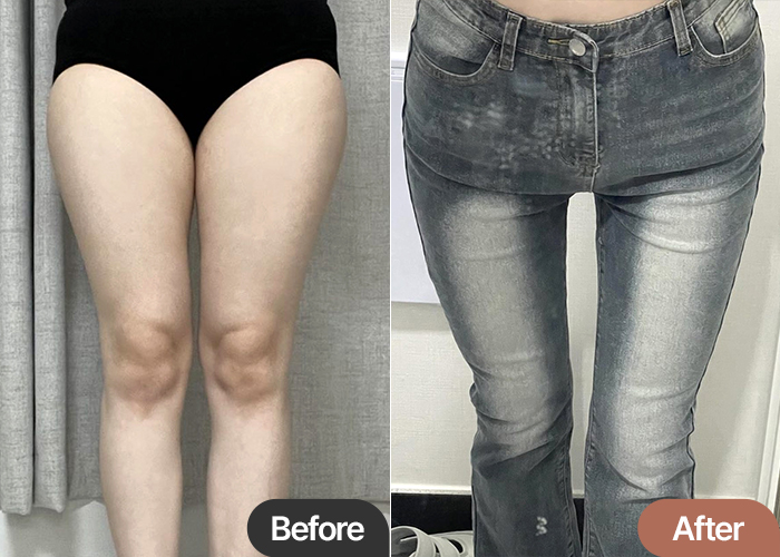 Thigh liposuction hip line NyangiQesco