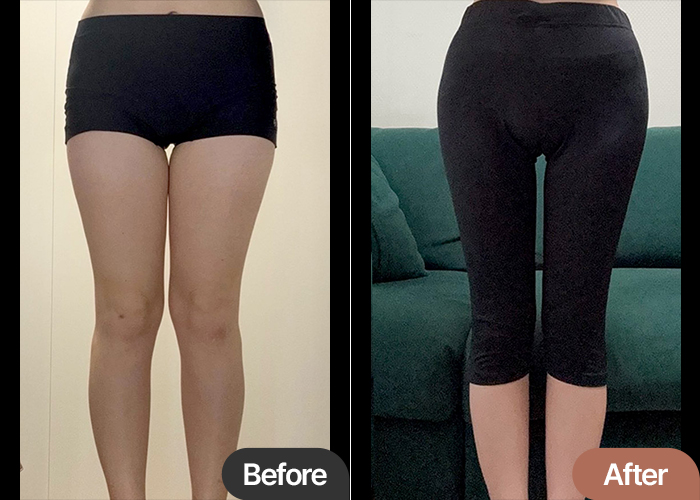 thigh-liposuction-thumbnail-selfie-Shiro