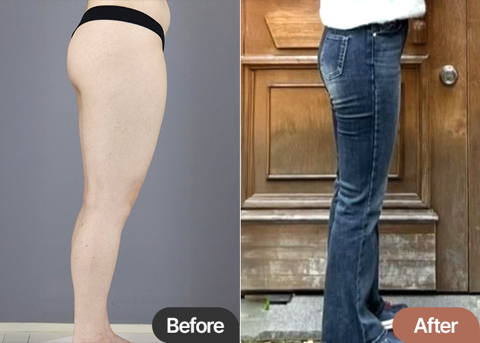 Before and after thigh liposuction of Tokkifwj2M in Korea—visible change in overall thigh thickness and shape.