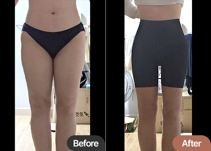 Before and after thigh liposuction & hip fat transfer of Wooogeax—clear reduction in inner thighs and curved hip volume.
