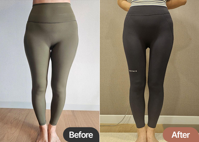 Before and after thigh liposuction of YeouKmC23 in Korea—clear volume reduction and improved pants fit.