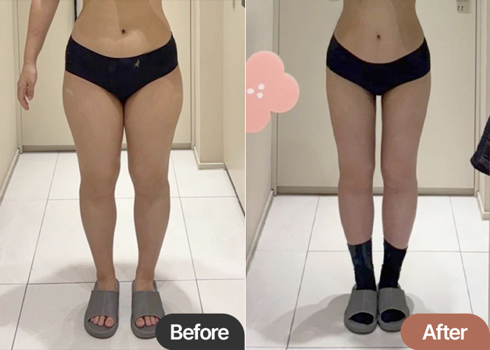 Before and after thigh liposuction of Ddklose in Korea—dramatic change in thigh shape, definition, and inner gap.