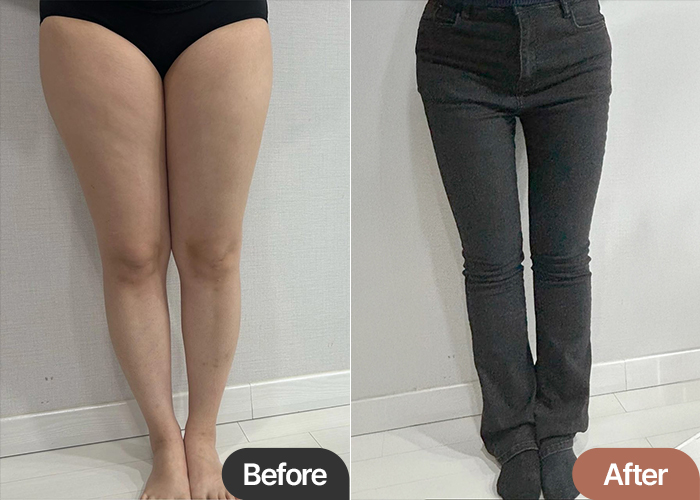 Before and after thigh liposuction of Whjdkc in Korea—significant change in inner thigh gap and hip contour.