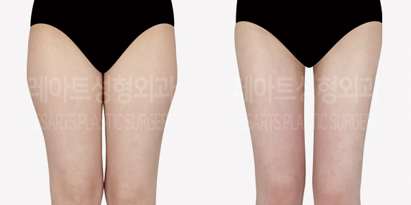 thigh_liposuction_01_thumbnail_240807