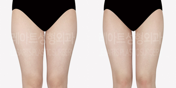 thigh_liposuction_01_thumbnail_240809