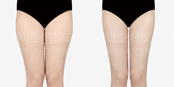thigh_liposuction_01_thumbnail_240812