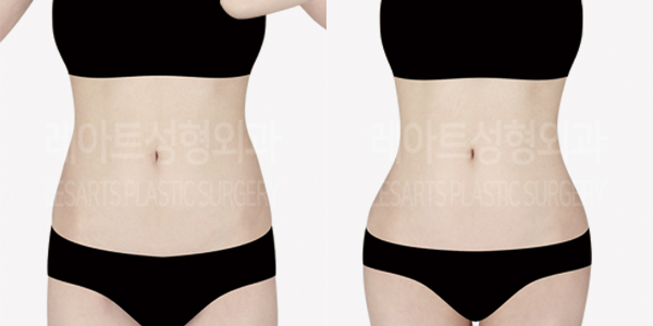thigh_liposuction_01_thumbnail_240822