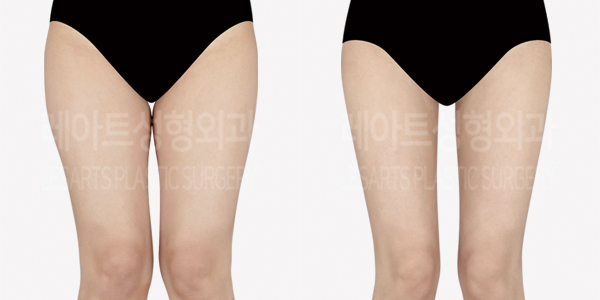 thigh_liposuction_01_thumbnail_240829