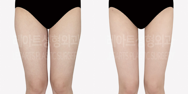 thigh_liposuction_01_thumbnail_240906
