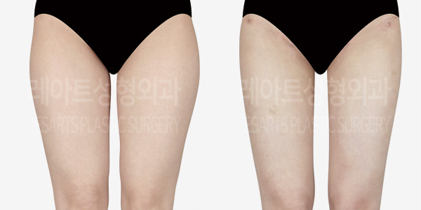 thigh_liposuction_01_thumbnail_240909
