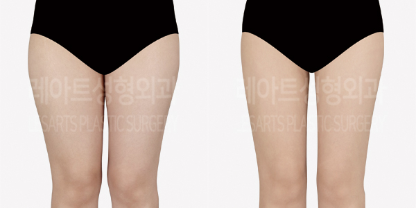 thigh_liposuction_01_thumbnail_240923