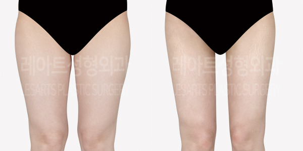 thigh_liposuction_01_thumbnail_240930