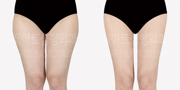 thigh_liposuction_01_thumbnail_241007