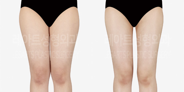 thigh_liposuction_01_thumbnail_241025