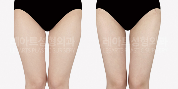 thigh_liposuction_01_thumbnail_241108
