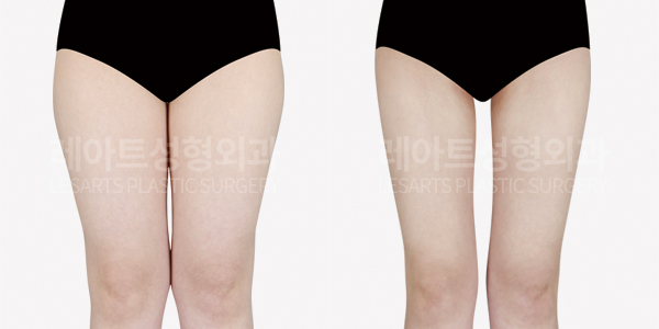 thigh_liposuction_01_thumbnail_241118