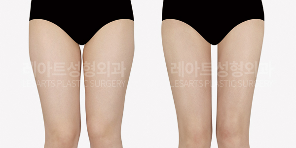 thigh_liposuction_01_thumbnail_241211