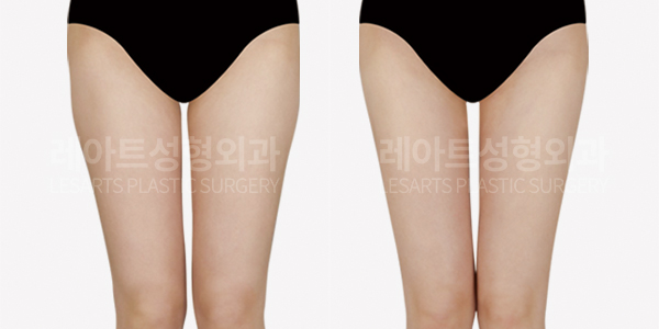 thigh_liposuction_01_thumbnail_241218