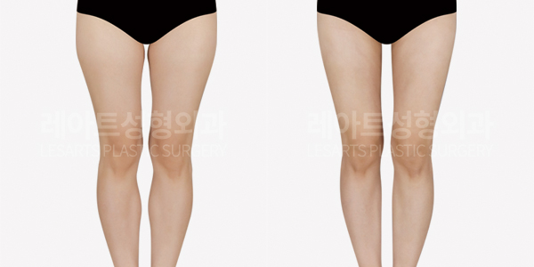 thigh_liposuction_01_thumbnail_250114