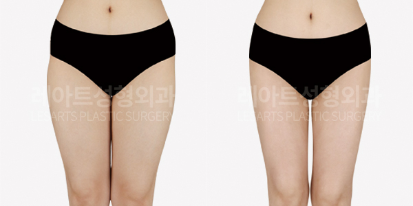 thigh_liposuction_01_thumbnail_250124