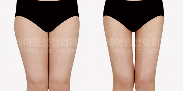 thigh_liposuction_01_thumbnail_250211
