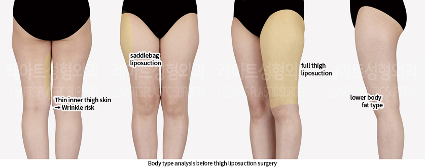 thigh_liposuction_02_01_240807