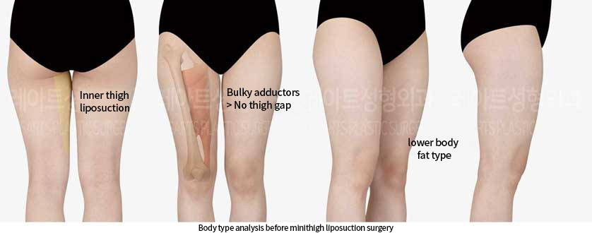 thigh_liposuction_02_01_240809