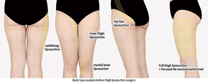 thigh_liposuction_02_01_240812