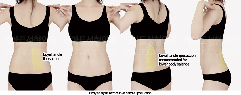 thigh_liposuction_02_01_240822