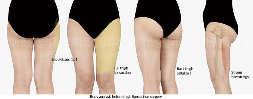 thigh_liposuction_02_01_240829
