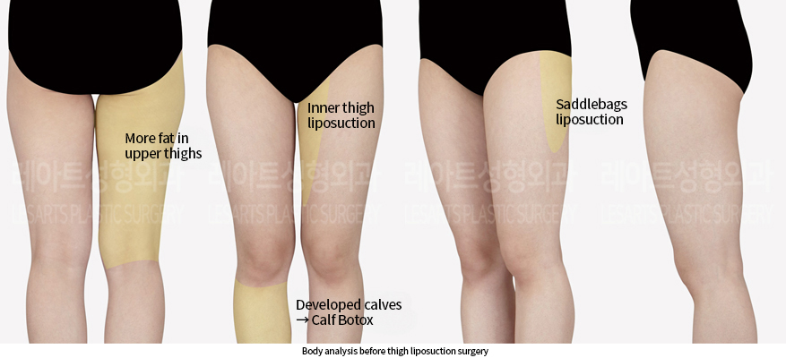 thigh_liposuction_02_01_240906