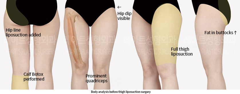 thigh_liposuction_02_01_240909