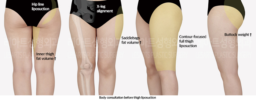 thigh_liposuction_02_01_240923