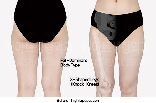 thigh_liposuction_02_01_240930