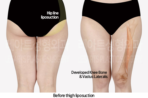 thigh_liposuction_02_01_241007