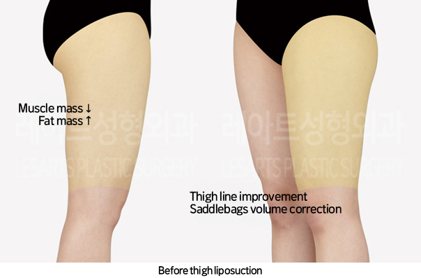 thigh_liposuction_02_01_241025