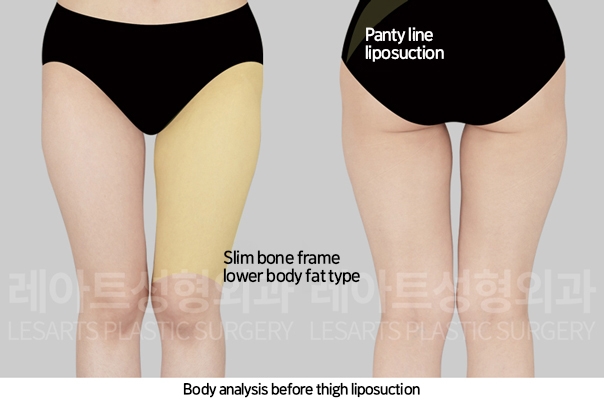 thigh_liposuction_02_01_241108