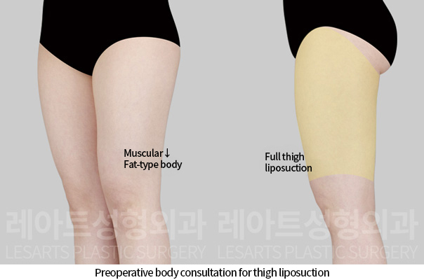 thigh_liposuction_02_01_241118