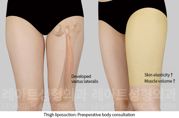 thigh_liposuction_02_01_241211