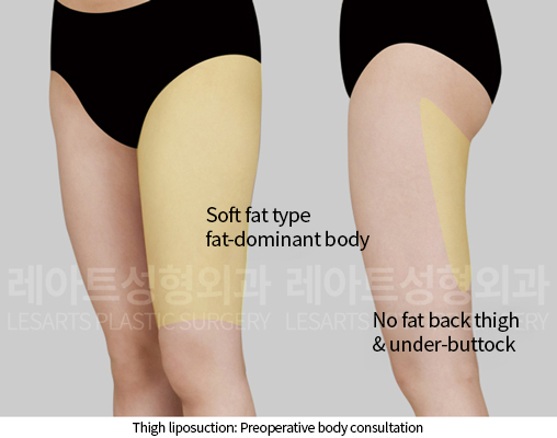 thigh_liposuction_02_01_241218