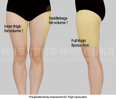 thigh_liposuction_02_01_250114