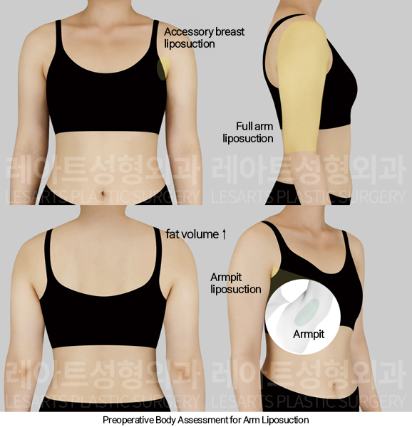 thigh_liposuction_02_01_250124
