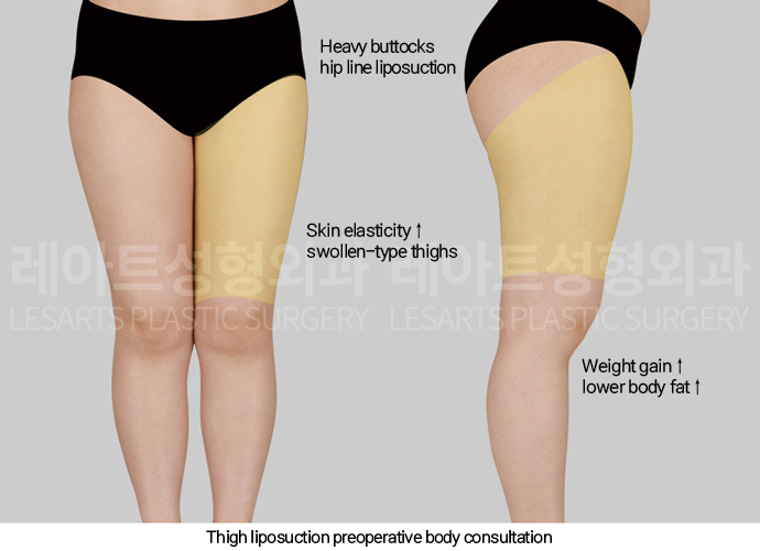 thigh_liposuction_02_01_250211