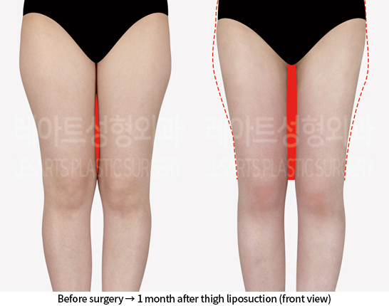 thigh_liposuction_02_02_240807
